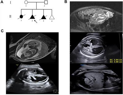 Case report: Prenatal diagnosis of fetal intracranial hemorrhage due to compound mutations in the JAM3 gene